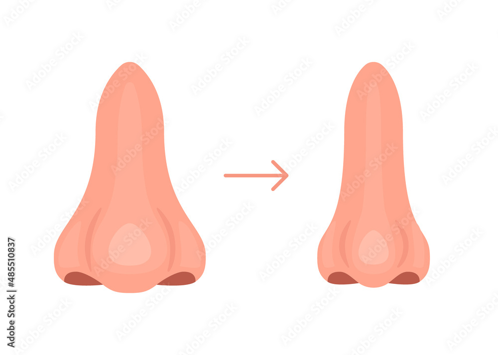 Rhinoplasty, change nose. Before and after plastic nose reduction surgery. Appearance correction in beauty industry. Surgical intervention. Vector Rhinoplasty, change nose. Before and after plastic nose reduction surgery. Appearance correction in beauty industry. Surgical intervention. Vector
