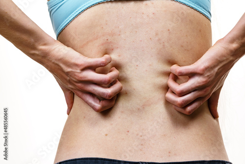Woman scratching her itchy back with allergy rash