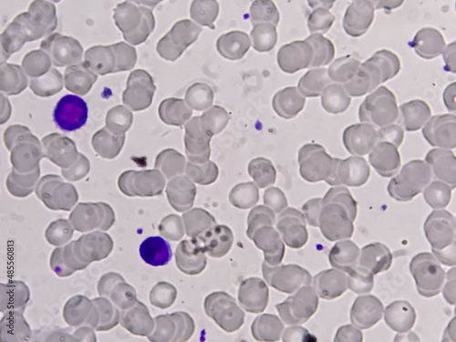 Blood smear microscopic show Reactive lymphocytes and Neutropenia. photo