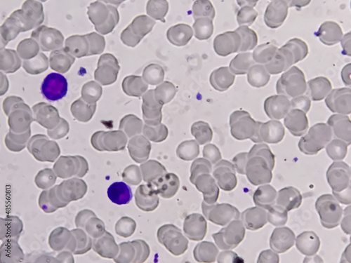 Blood smear microscopic show Reactive lymphocytes and Neutropenia.