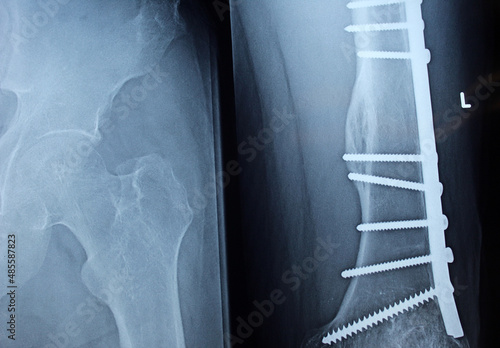 Plain X ray on the left femur that shows united mid shaft left femur fracture after open reduction orthopedic surgery with internal fixation with broad metallic Dynamic Compression Plate and screws photo