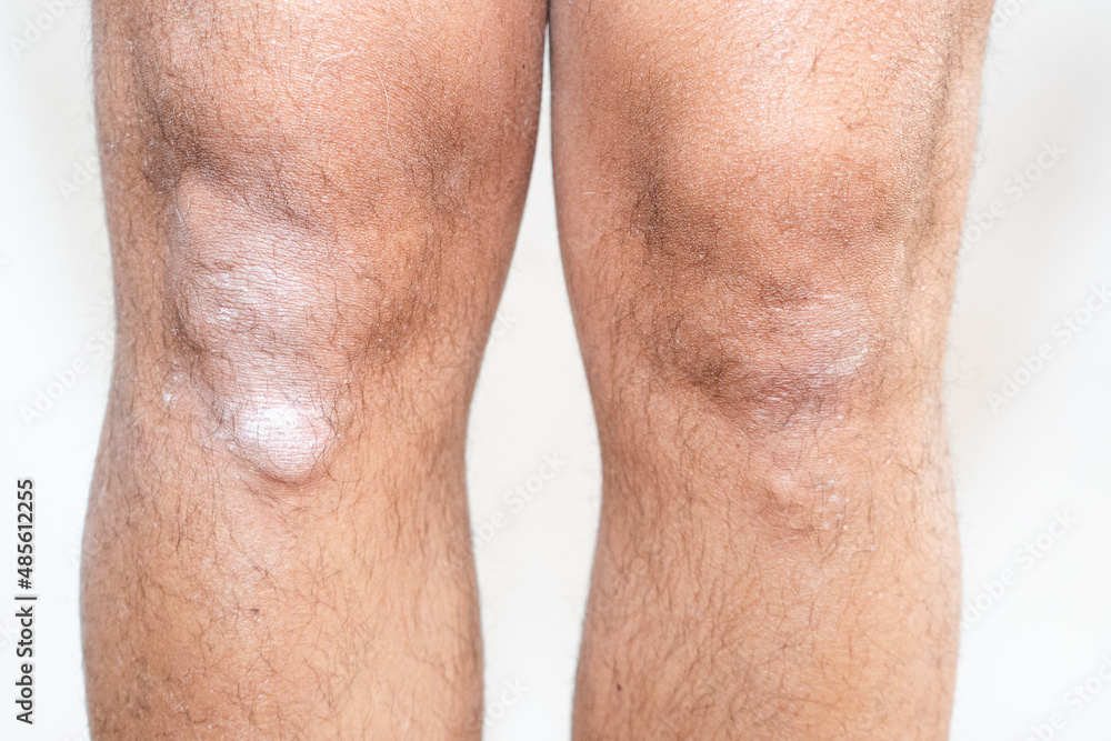 RODILLAS DE HOMBRE CON PSORIASIS RODILLAS DE HOMBRE CON PSORIASIS