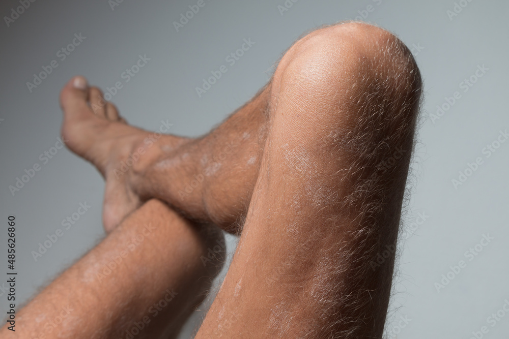 Naklejka premium Large plaque parapsoriasis on caucasian man legs