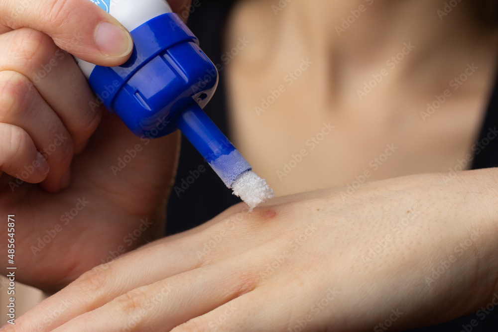 Closeup of a woman freezing a wart on her hand at home.