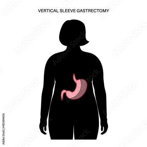 Laparoscopic sleeve gastrectomy