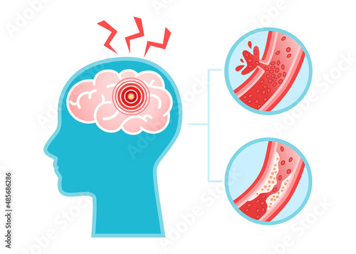 Human head with brain stroke disease, atherosclerosis, hemorrhage and pain point. Vector flat infographic medical concept illustration. Design for poster, print, background, landing page