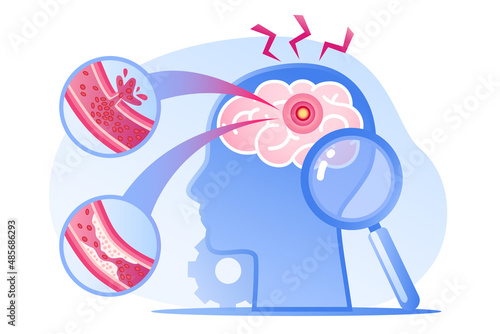 Human head with brain stroke disease, atherosclerosis, hemorrhage and pain point. Vector flat infographic medical concept illustration. Design for poster, print, background, landing page