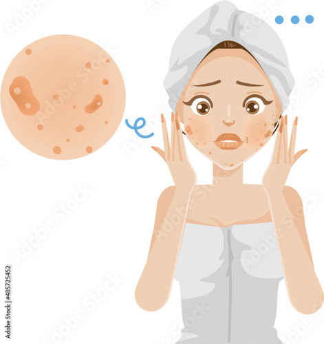 cystic acne female face skin. girl wrapped in towel