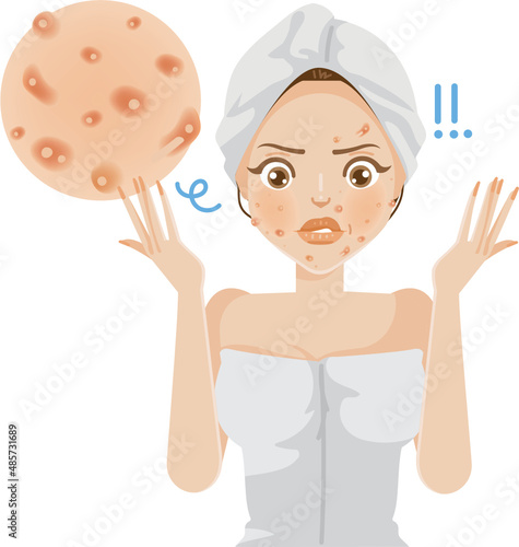 inflammatory acne female face skin. girl wrapped in towel