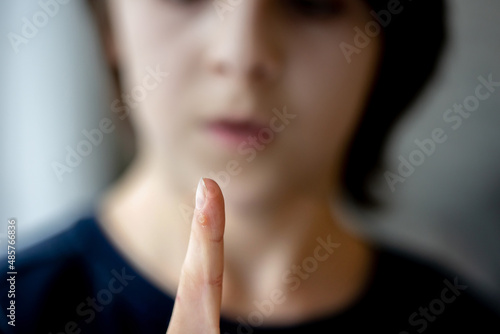 Child, preteen boy, showing wart on his finger, focus on the finger photo