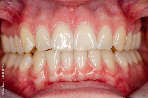 Billede på lærred close up of teeth in occlusion