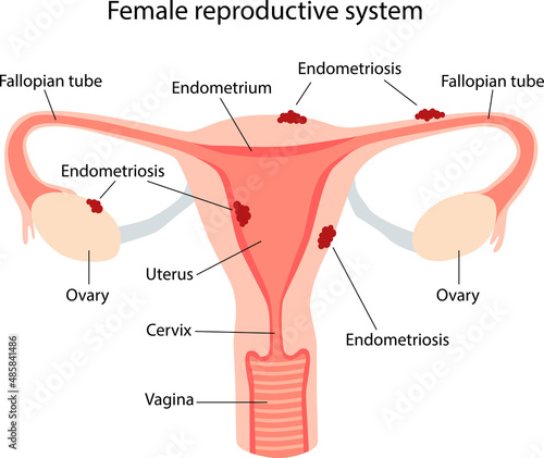 Endometriosis, schematic illustration of the female reproductive system diseases