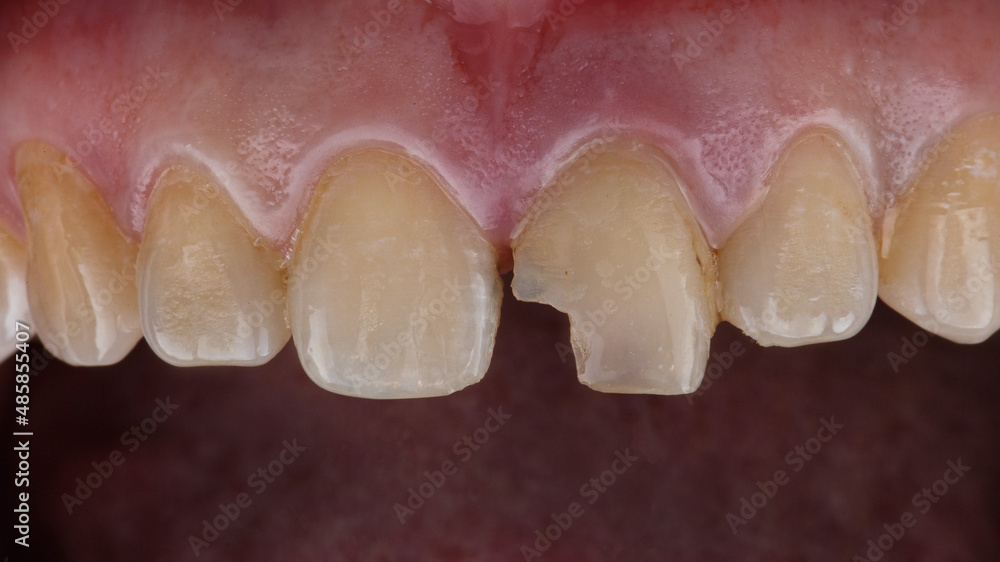 Photography central tooth with a large chipped destruction