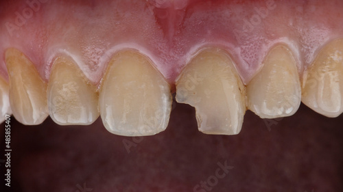 Vászonkép central tooth with a large chipped destruction