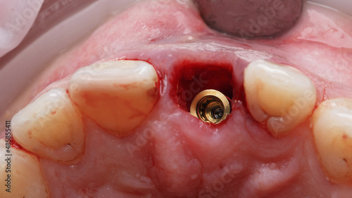 dental abutment gold color after implantation