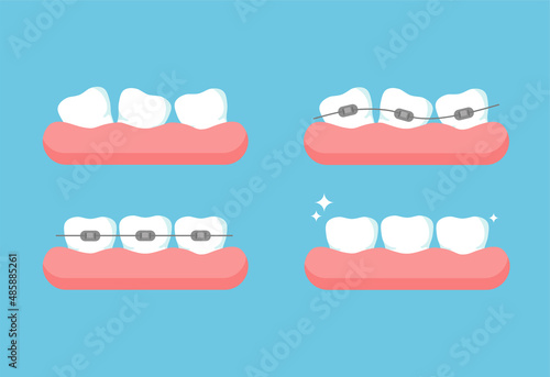 Stages of orthodontic treatment. Teeth without dental braces and after correction. Vector illustration isolated on blue background.