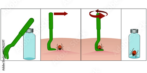 Illustration of special tweezers for removing ticks. Instructions for removing a tick with special tweezers. Tick ​​bite. Placing the tick in a container. Vector illustration