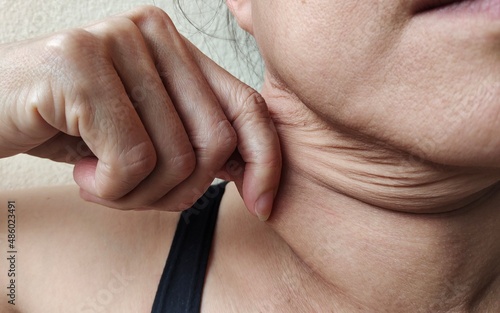 Obraz na plátně Portrait the hand squeezing adipose hanging skin under the neck, problem flabbiness double layered skin under the chin of woman, concept health care