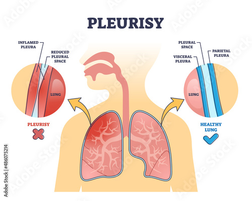 Pleurisy or pleuritis disease as medical lung inflammation outline diagram. Labeled educational scheme with healthy vs inflamed pleura difference and anatomical visceral comparison vector illustration
