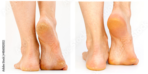Foto Image before and after treatment of dry heels cracks skin dehydrated skin on heels and sole of female feet