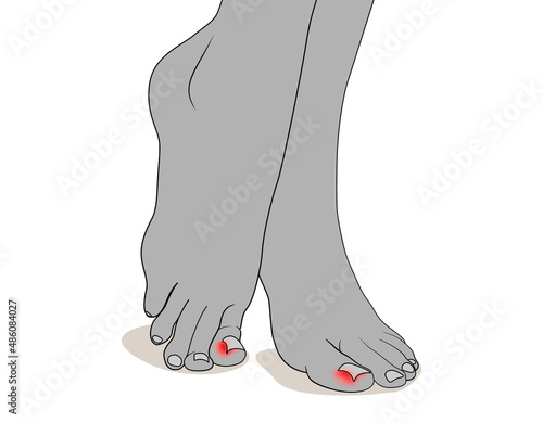 Feet with ingrown nails. Podiatry. Black and white vector illustration