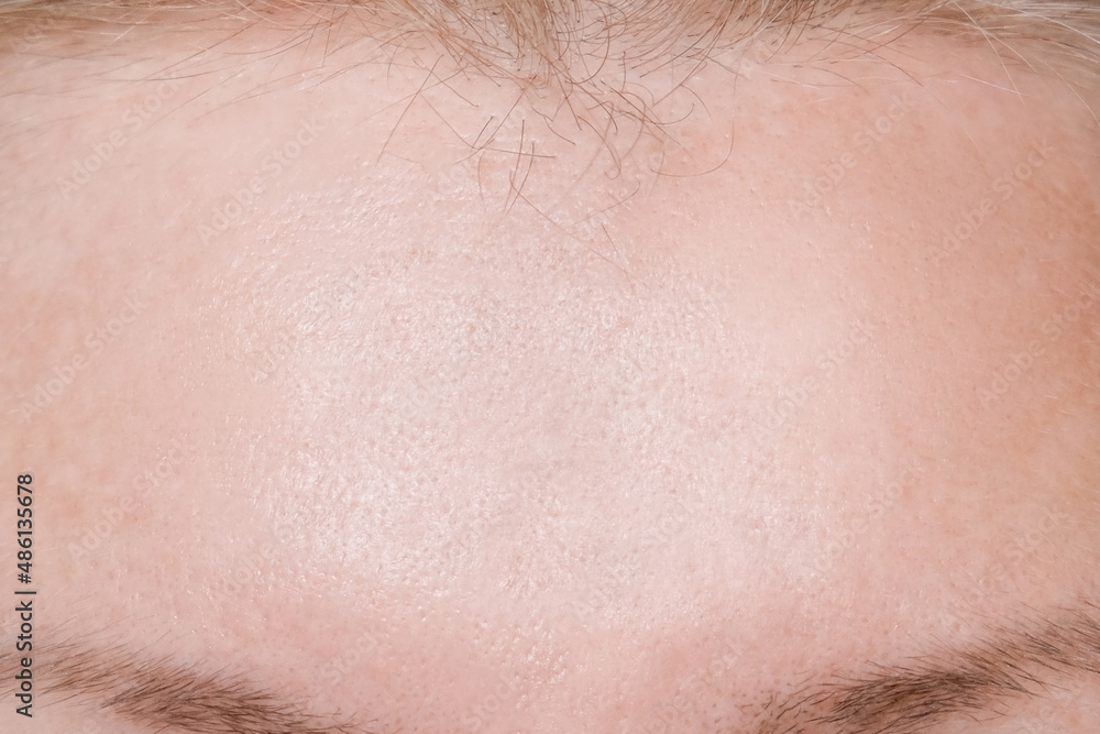 Woman face wrinkle on forehead after rejuvination procedures, injections, treatment, surgery Woman face wrinkle on forehead after rejuvination procedures, injections, treatment, surgery