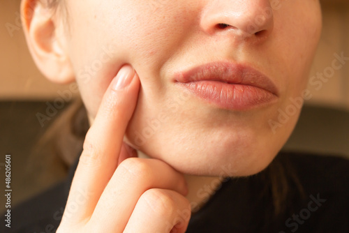 Young woman points her finger at her lips infected herpes virus. Indignation look. Diseases of the immune system. photo