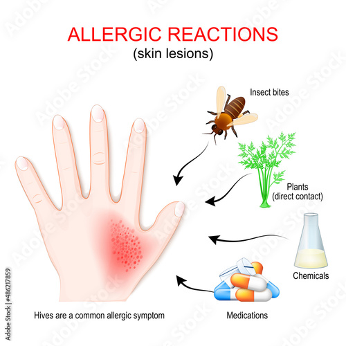 allergic reaction and skin lesions. Human hand with skin rash