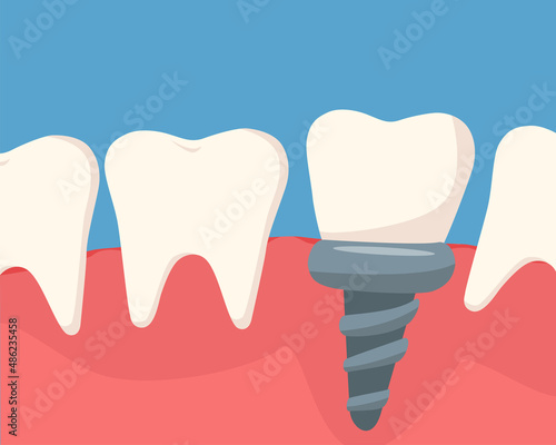 Dental cavity concept. Dental implant in cartoon design. The dental implant is screwed into the gum