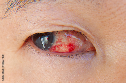 Closeup Asian man eye with subconjunctival hemorrhage photo