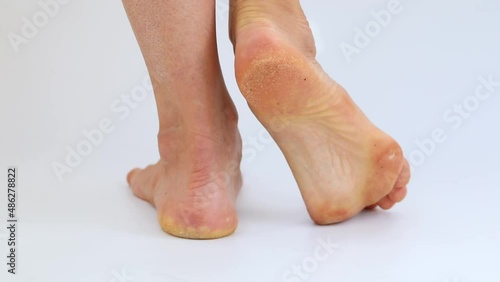 Woman lift her foot and shows sole with Dry skin, plantar callosity and flakes on the female heel and feet sole close up on white background. Fooage for medical purposes. photo