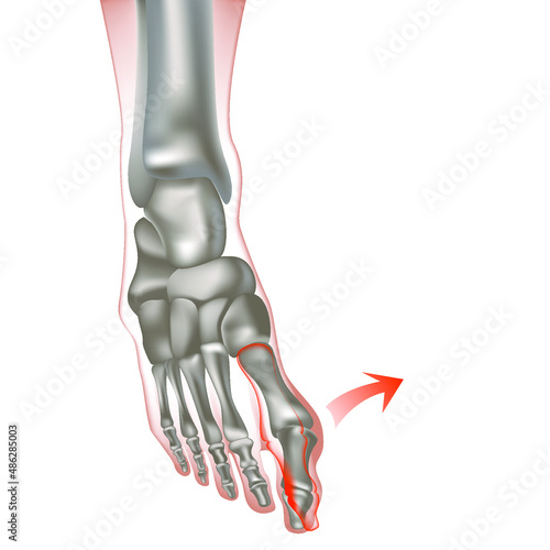 Valgus deformity of the big toe. Bones on the feet or bumps on the feet, gout. deviation of the big toe, first outward. Anatomy of joints and bones. Vector illustration