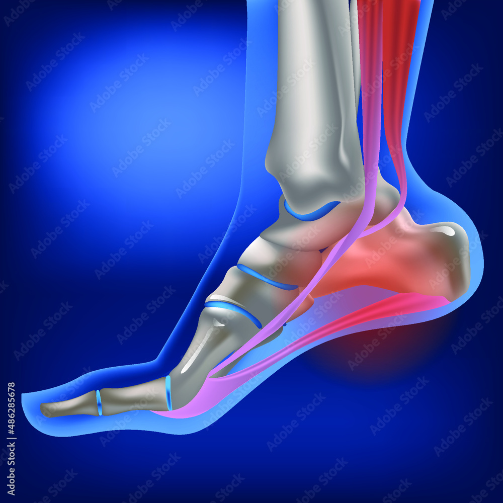 Plantar fasciitis, plantar fasciosis. inflammatory and degenerative