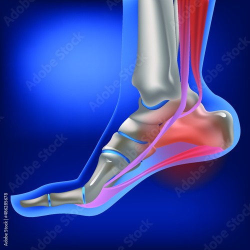 Plantar fasciitis, plantar fasciosis. inflammatory and degenerative changes in plantar fascia. Pain during walking. Vector 3D rendering of the human foot in flexed position