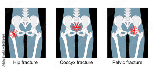 hip fracture, break of the sacrum or pelvis, pain in the coccyx