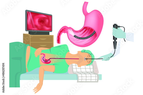Sleep gastroscopy. A patient on a medical bed with an endoscope in the stomach inserted through the oral cavity. Medical poster. Vector illustration