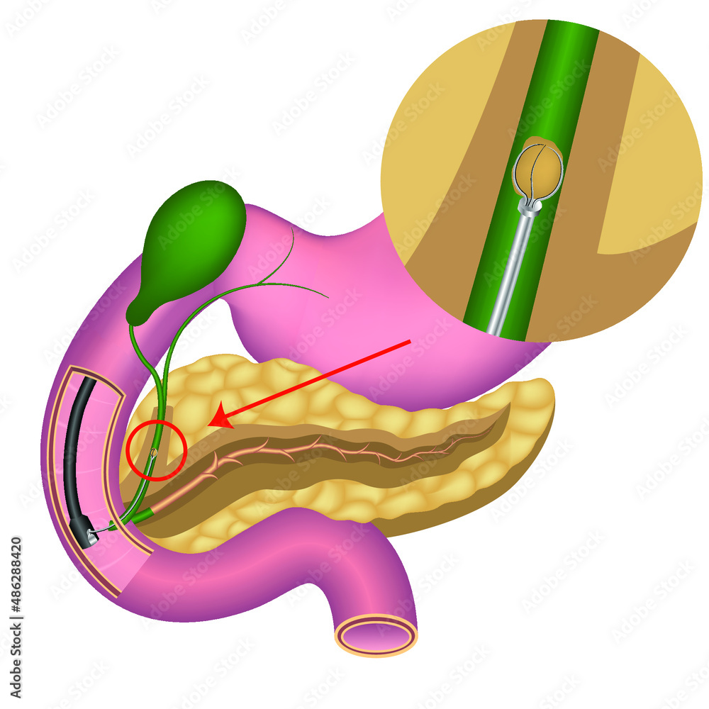 endoscopic removal of gallstones from the gallbladder ducts. Pancreas