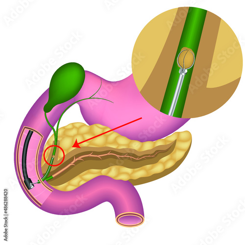 endoscopic removal of gallstones from the gallbladder ducts. Pancreas. Digestive organs anatomy. Operation through the stomach. Vector medical illustration