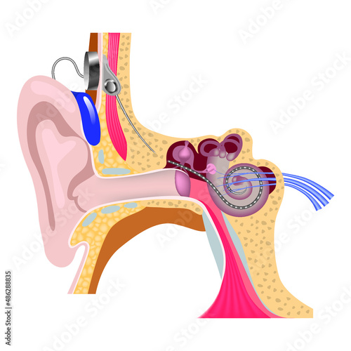 cochlear implantation system. Hearing back with inner ear surgery. Electron array. Vector illustration photo