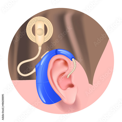 Cochlear implant. Hearing aid in the ear. Sensorineural hearing loss. Deafness treatment. Prosthesis for the auditory nerve. Hearing loss compensation. Vector illustration