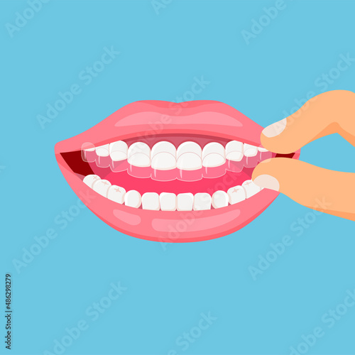 Mouth guard. Teeth with transparent braces. Alignment of teeth by aligners. Orthodontic dentistry concept. Dental care. Vector illustration isolated on blue background.