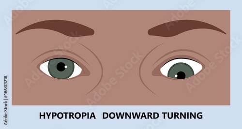 Diplopia double vision test exam brain nerve dry eye palsy gravis muscle loss head brain tumor squint ptosis gaze myopia miosis tropia Phoria maddox rod horner's ocular amblyopia Lazy stroke abducens