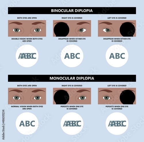 Diplopia double vision test exam brain nerve dry eye palsy gravis muscle loss head brain tumor squint ptosis gaze myopia miosis tropia Phoria maddox rod horner's ocular amblyopia Lazy stroke abducens