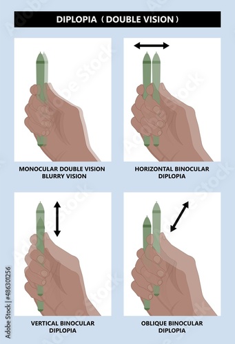 Diplopia double vision test exam brain nerve dry eye palsy gravis muscle loss head brain tumor squint ptosis gaze myopia miosis tropia Phoria maddox rod horner's ocular amblyopia Lazy stroke abducens