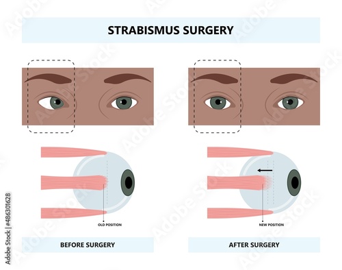 Diplopia double vision test exam brain nerve dry eye palsy gravis muscle loss head brain tumor squint ptosis gaze myopia miosis tropia Phoria maddox rod horner's ocular amblyopia Lazy stroke abducens