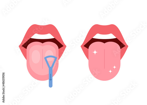 Clean tongue throat cleaner scraper in mouth. Before and after tongue cleaning. Halitosis prevention. Vector illustration photo