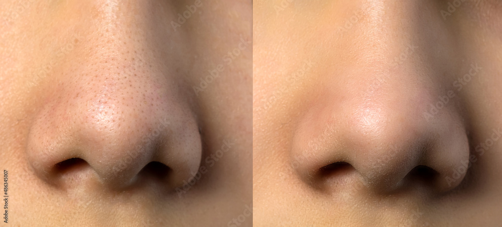 Retouched image compared before and after treatment blackhead acne on the nose. Skin care Beauty process concept.
Retouched image compared before and after treatment blackhead acne on the nose. Skin care Beauty process concept.