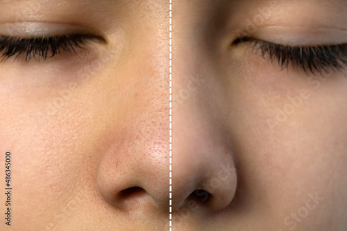 Retouched image compared before and after treatment blackhead acne on teenager boy's nose. Beauty process concept. photo