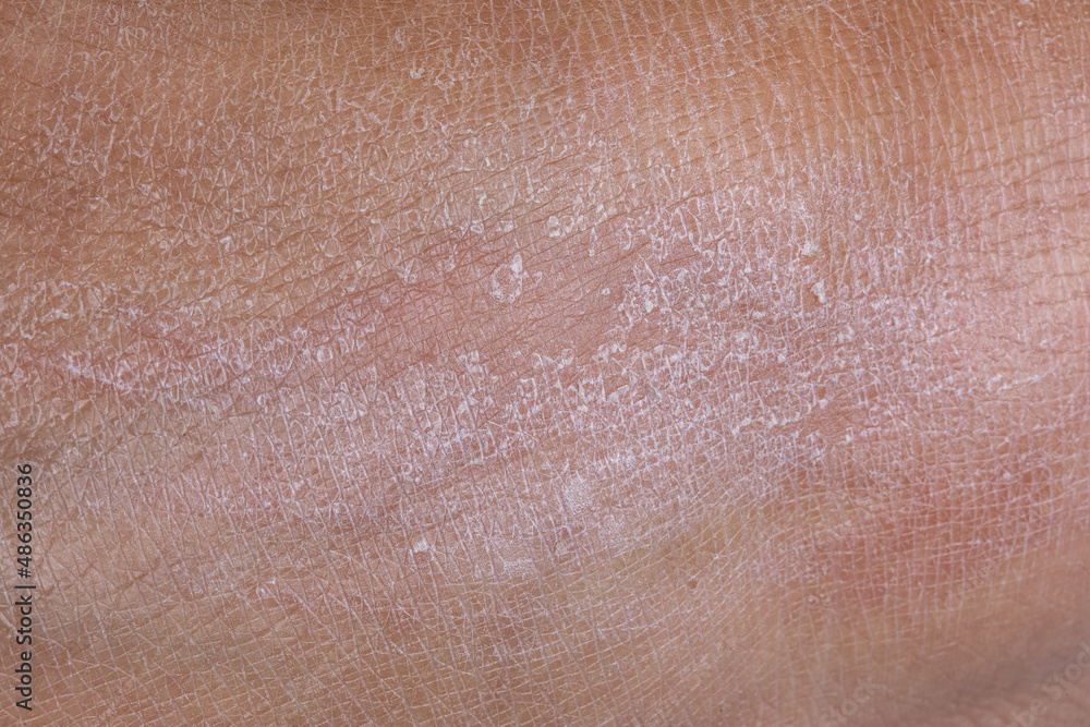 Damaged dry skin condition surface