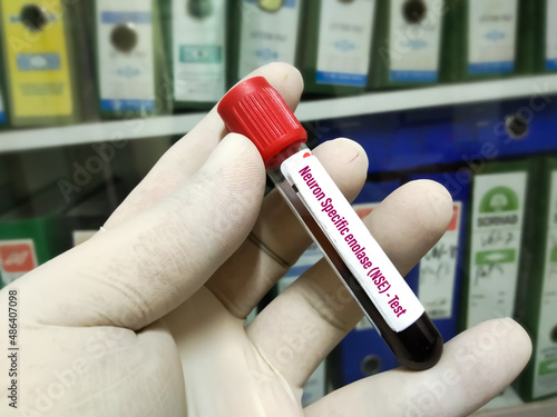 Blood sample for Neuron-specific Enolase or NSE Blood Test. To diagnosis and ongoing monitoring of patients with small cell lung carcinoma photo
